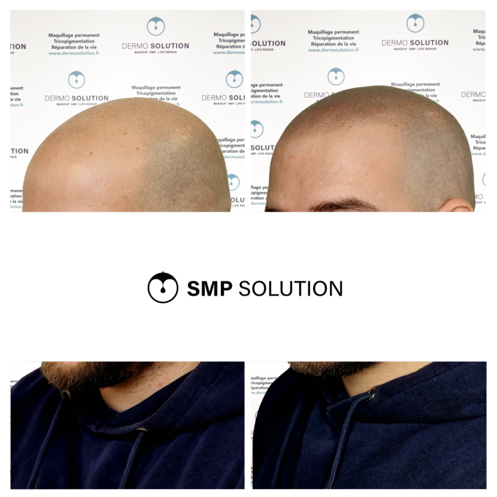 avant apres tricopigmentation capillaire