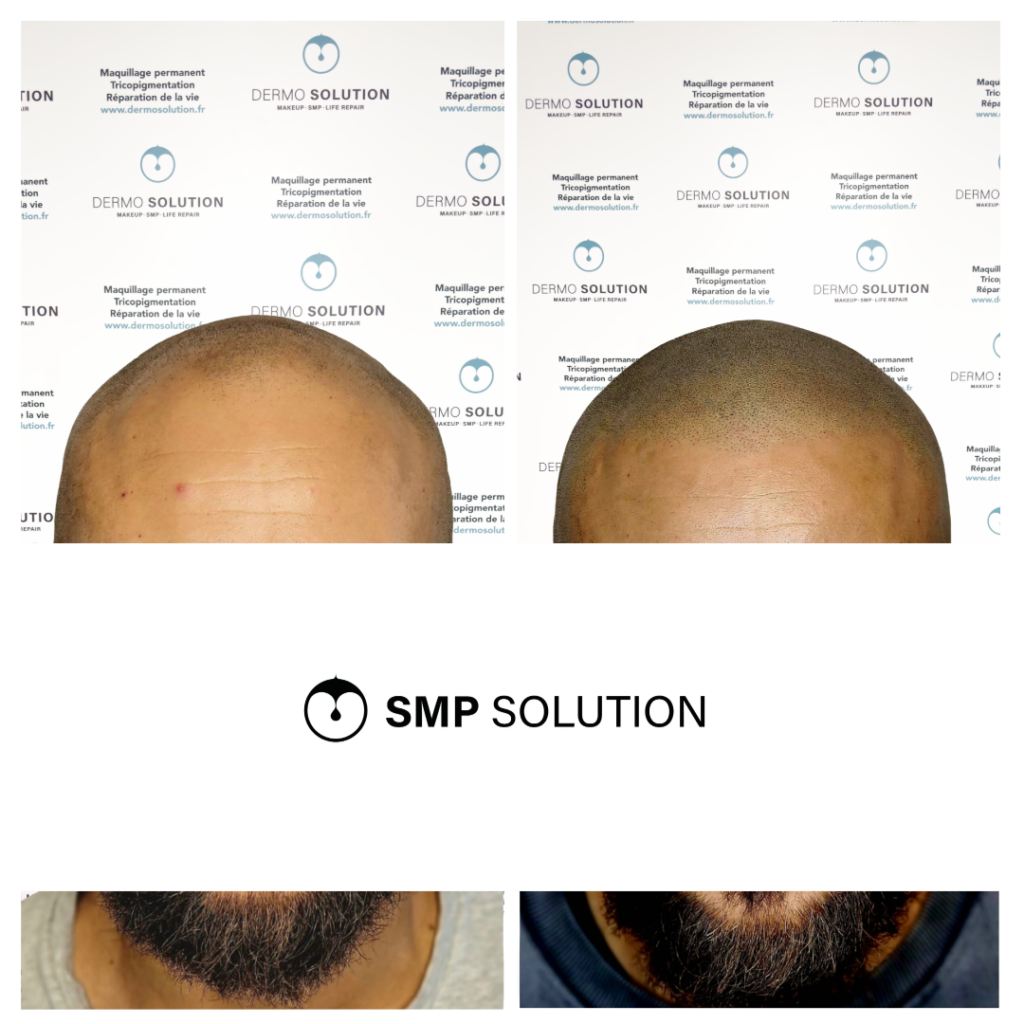avant apres tricopigmentation capillaire