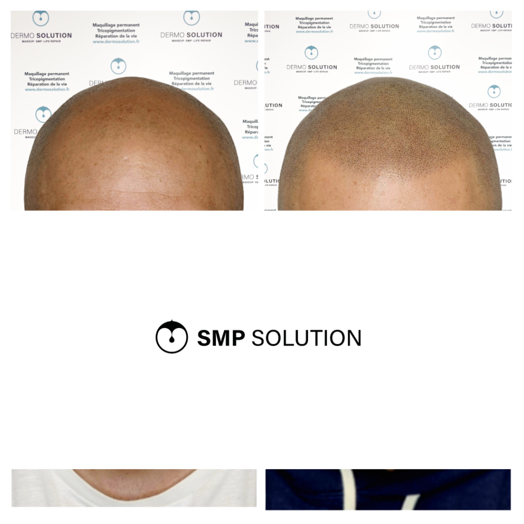 avant apres tricopigmentation capillaire