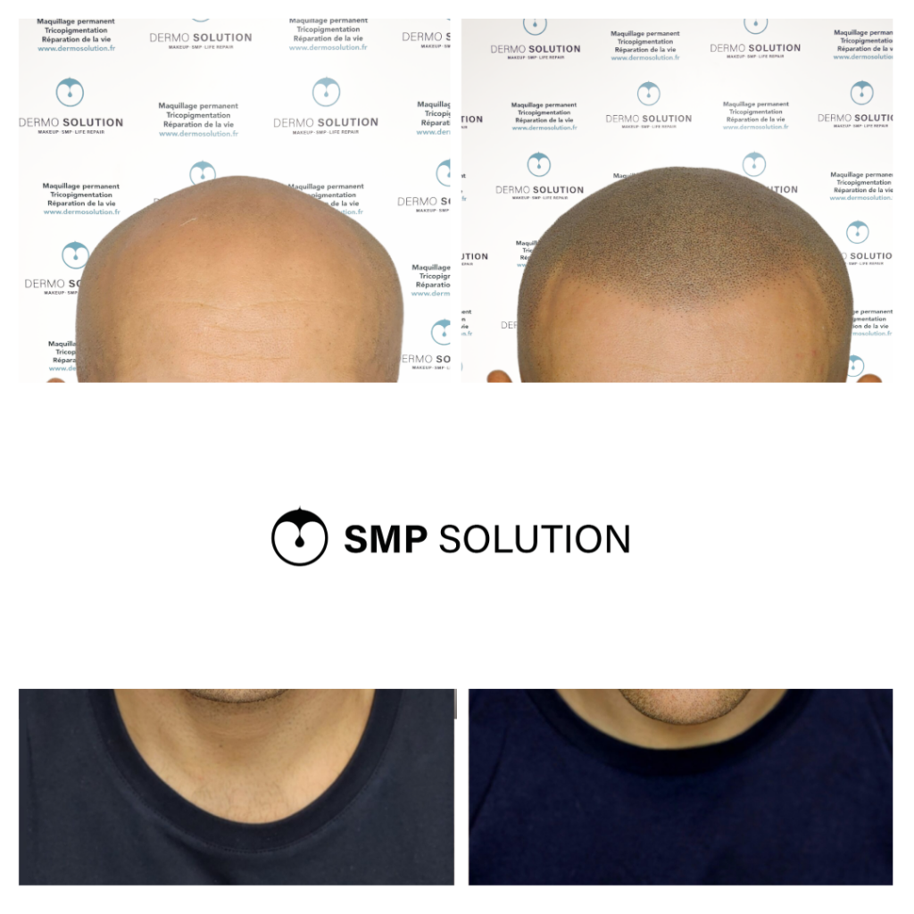 avant apres tricopigmentation capillaire