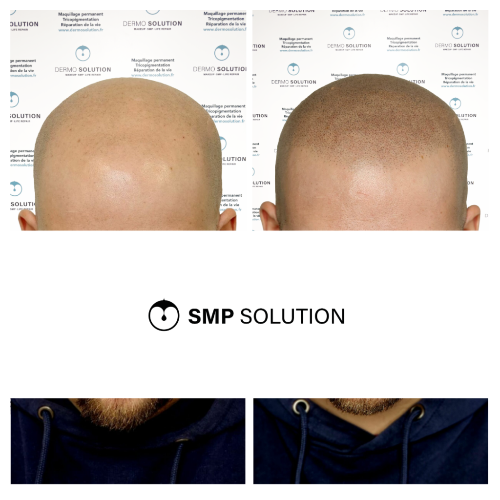 avant apres tricopigmentation capillaire