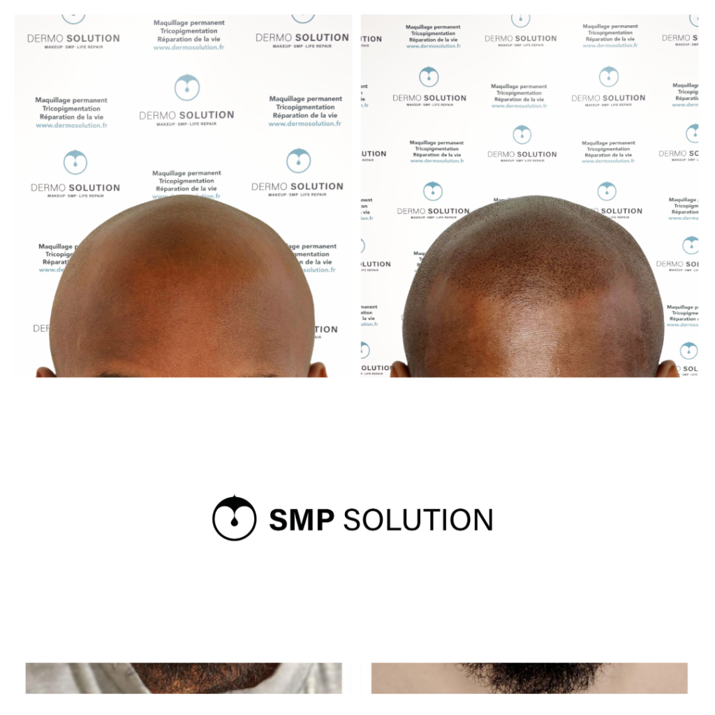 avant apres tricopigmentation capillaire