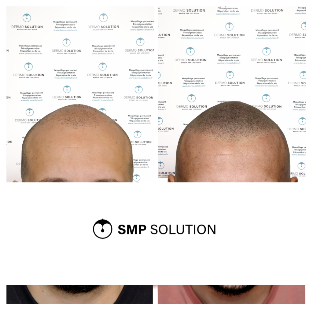 avant apres tricopigmentation capillaire